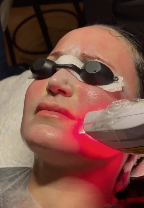 Aplicação de LED após peeling químico facial